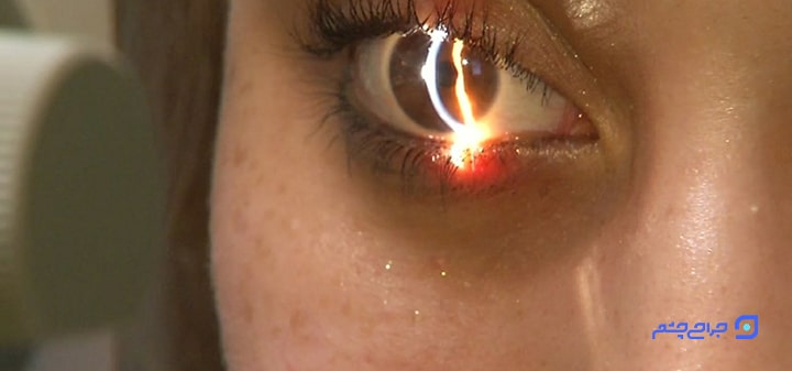 شرایط لازم برای جراحی های لیزری چشم