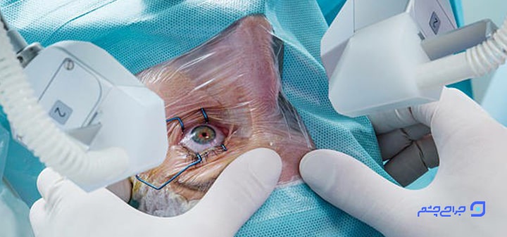 آمادگی های پیش از عمل جراحی لیزری چشم