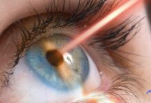 جراحی های لیزری چشم