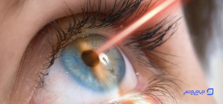 جراحی های لیزری چشم