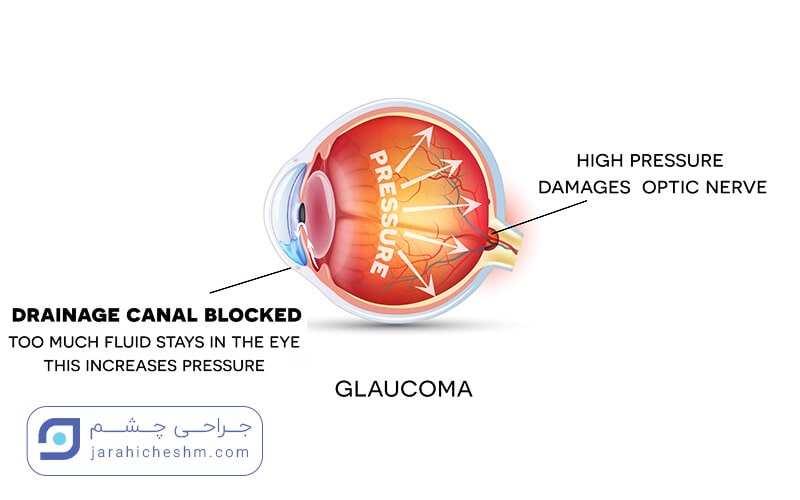 گلوکوم و درمان جراحی کاهنده فشار چشم؛ انواع گلوکوم