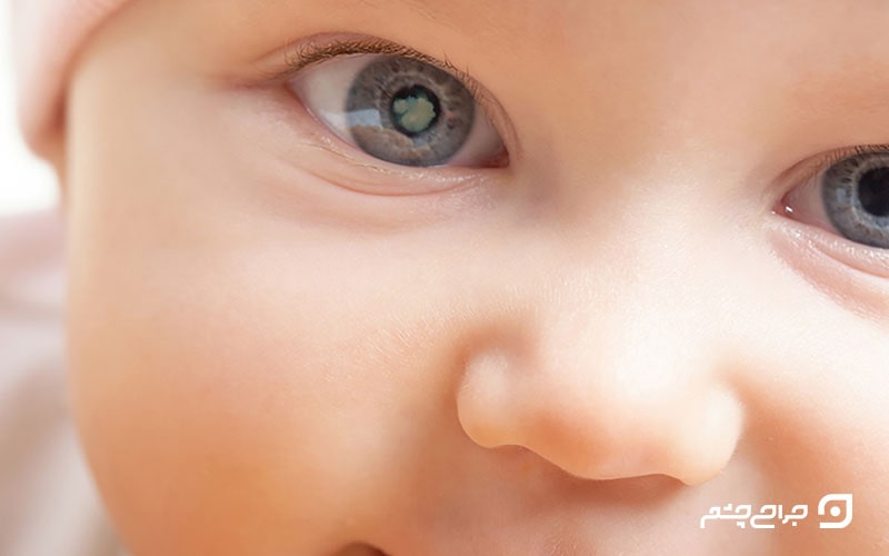 بیماری آب مروارید چشم مادرزادی؛ معاینه بعد از عمل