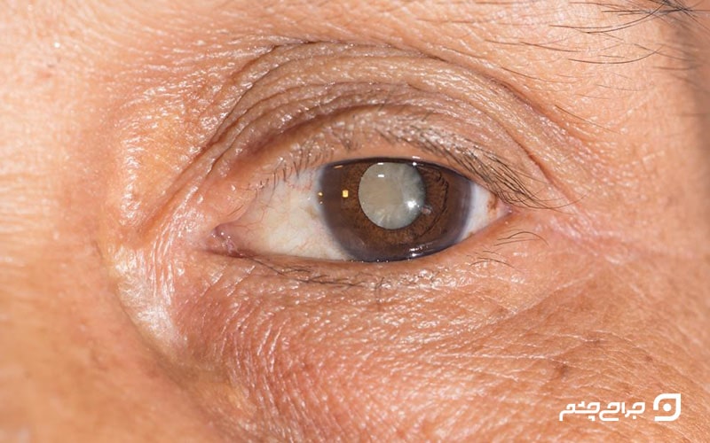 بیماری آب مروارید چشم؛ علل آب مروارید یا کاتاراکت