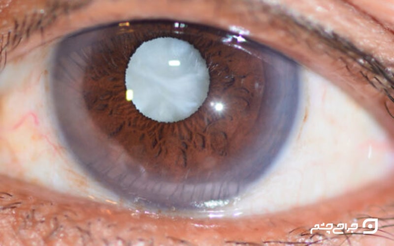 بیماری آب مروارید چشم؛ روش درمان آب مروارید ( کاتاراکت چشم ) 