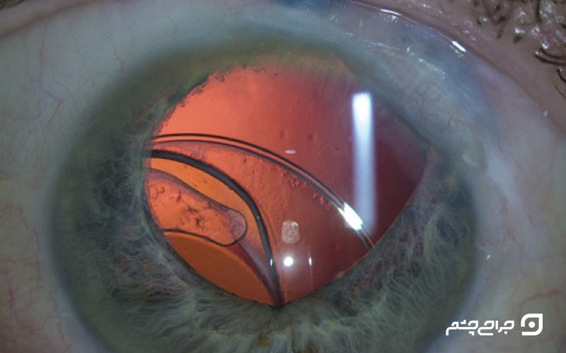 مراحل قرارگیری لنز های داخل چشمی