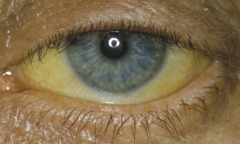 عوارض زردی چشم و یرقان