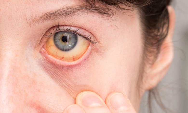 علت و دلایل زرد شدن سفیدی چشم