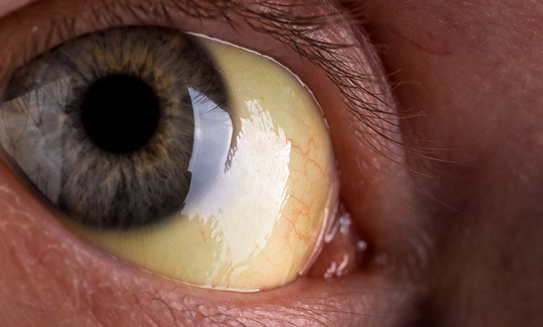 درمان خانگی زردی چشم