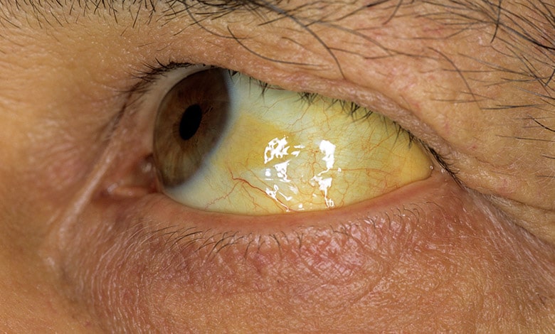 علائم و نشانه های زرد شدن سفیدی چشم ( یرقان )